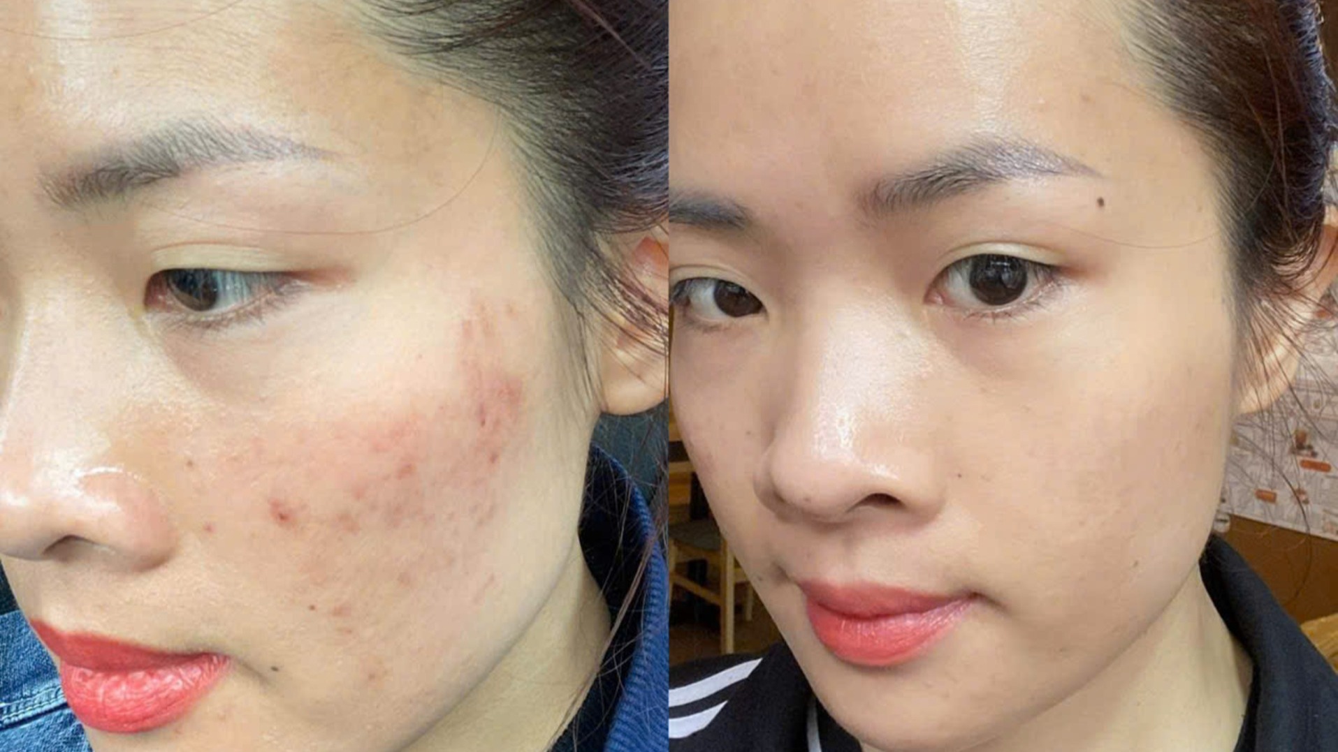 Tảo DÉCAAR điều trị mụn ẩn và thâm mụn