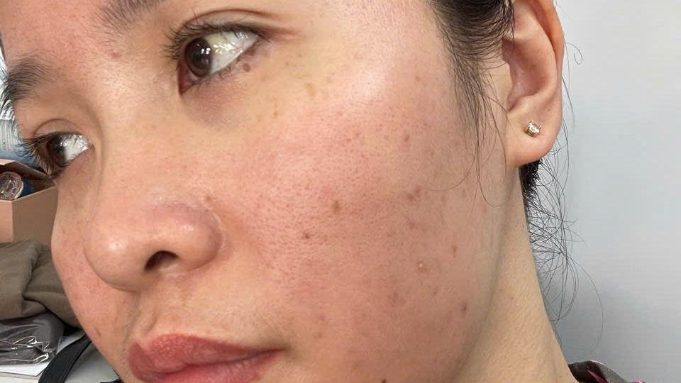 Tảo DÉCAAR điều trị mụn ẩn và thâm mụn Lâu Năm