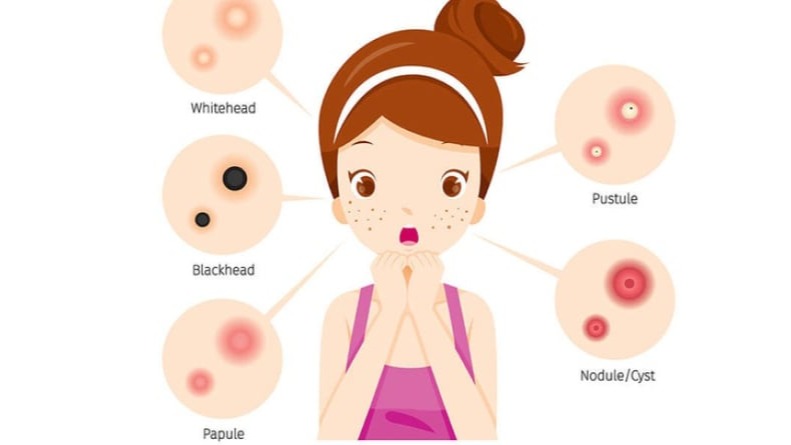 Những Điều Cần Làm Khi Mọc Mụn Ở Tuổi Dậy Thì