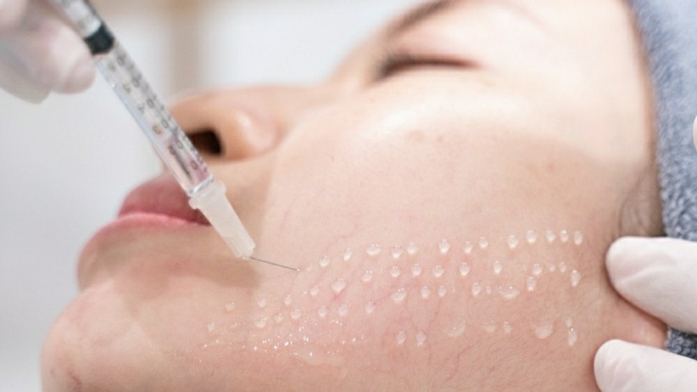 MESOTHERAPY